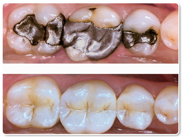 White Fillings Headington, Composite Fillings Oxford